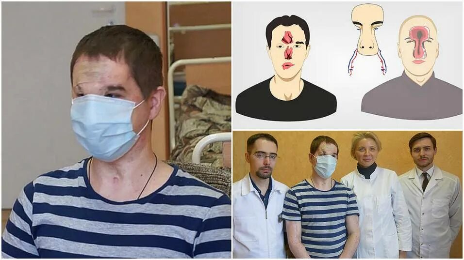 Как выглядит пересаженное лицо Из красавца в старика: в США впервые в мире провели успешную пересадку рук и лиц