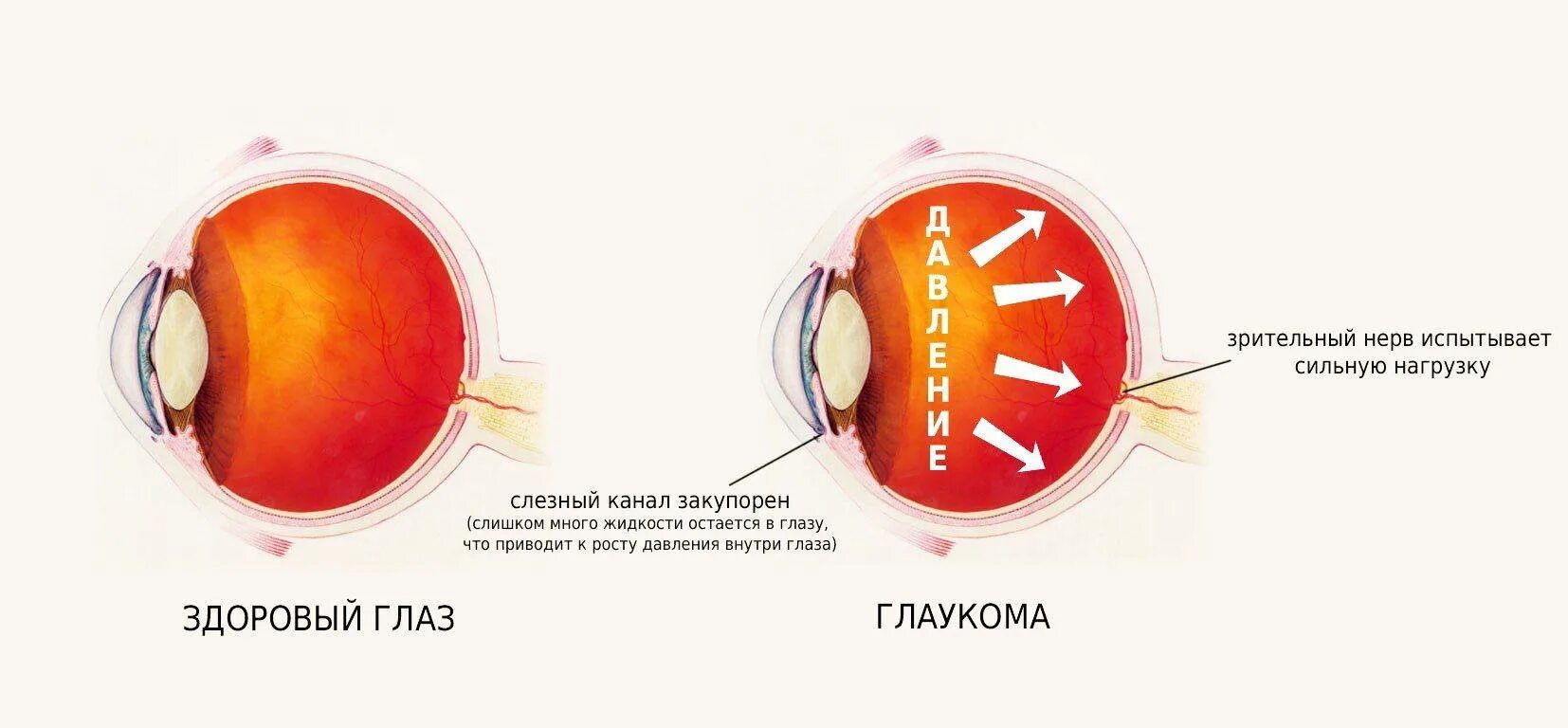 Патологии зрительного нерва глаукома. Глаукома схема глаза.