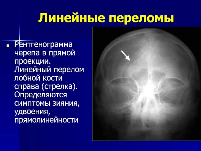 Трещина в голове. Линейный перелом лобной кости рентген. Перелом основания свода черепа на рентгене. Линейный перелом черепа рентген. Перелом теменной кости черепа рентген.