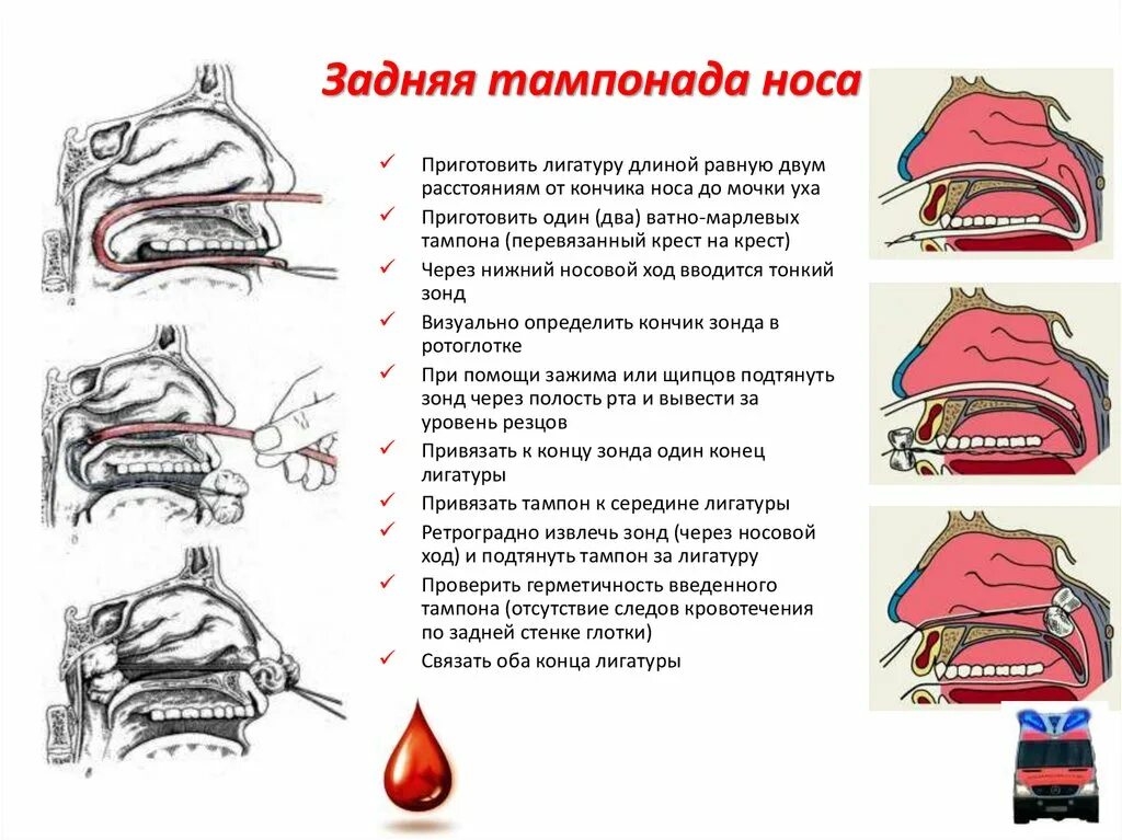 Сон доставать из носа. Задняя тампонада носа алгоритм. задняя тампонада полости носа техника. передняя тампонада полости носа при кровотечении. задняя тампонада носовой полости.