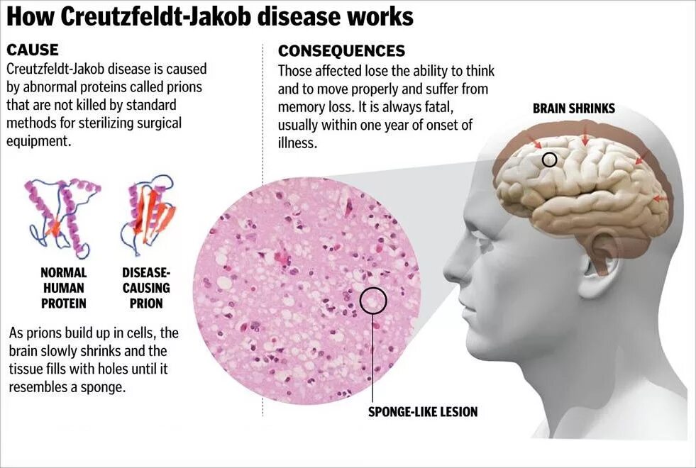 Brain disorders. Болезнь Крейтцфельдта-Якоба. Болезнь Крейтцфельдта Якоба прион. Болезнь крейсфельдда Якобса.