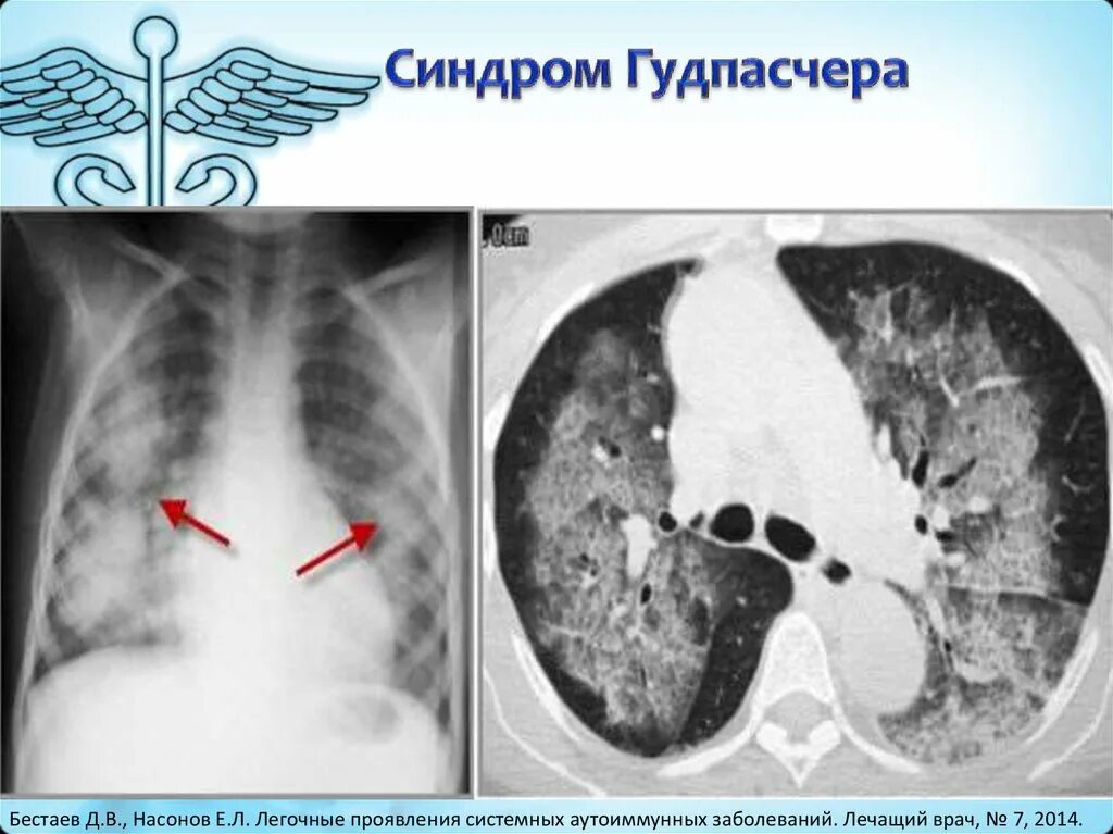 Синдром гудпасчера это. Синдром гудпасчера поражение легких. синдром гудпасчера рентгенограмма. гудпасчера кт легких болезнь. болезнь гудпасчера рентген.
