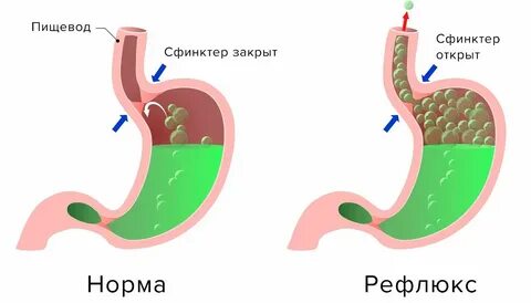 Гастроэзофагеальный без эзофагита
