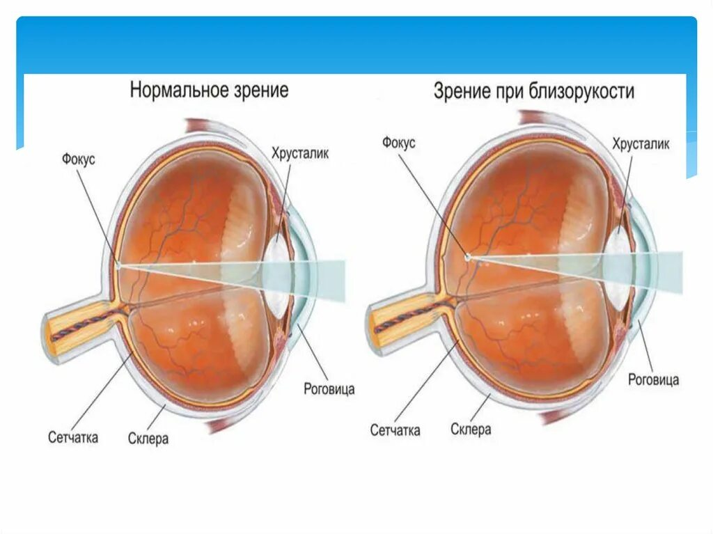 Близорукость глаз. Нормальное зрение и зрение при близорукости. Близорукость сетчатка. Строение глаза при миопии.