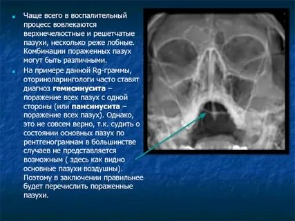 Гиперплазия слизистой верхнечелюстной