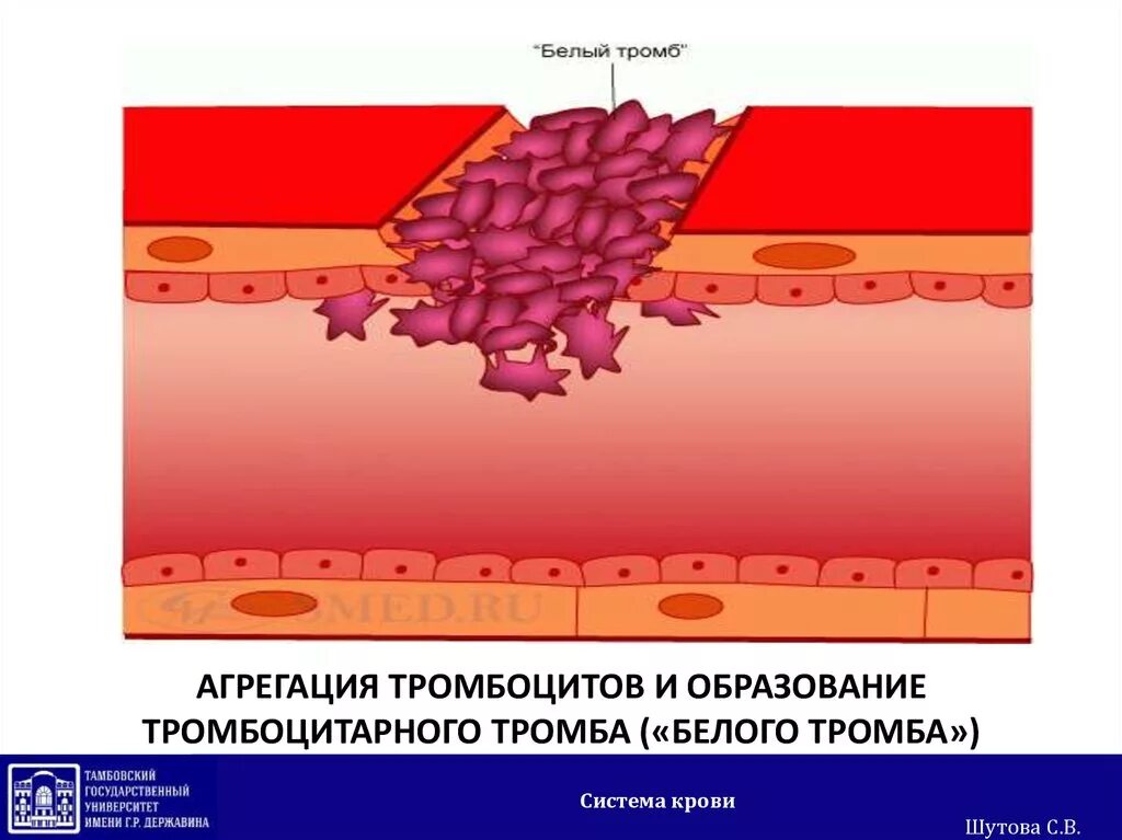 Тромбоциты крови тромб образование. Образование тромбоцитарного тромба. Образование белого тромба. Агрегация тромбоцитарного тромба. Тромбоциты и тромбы