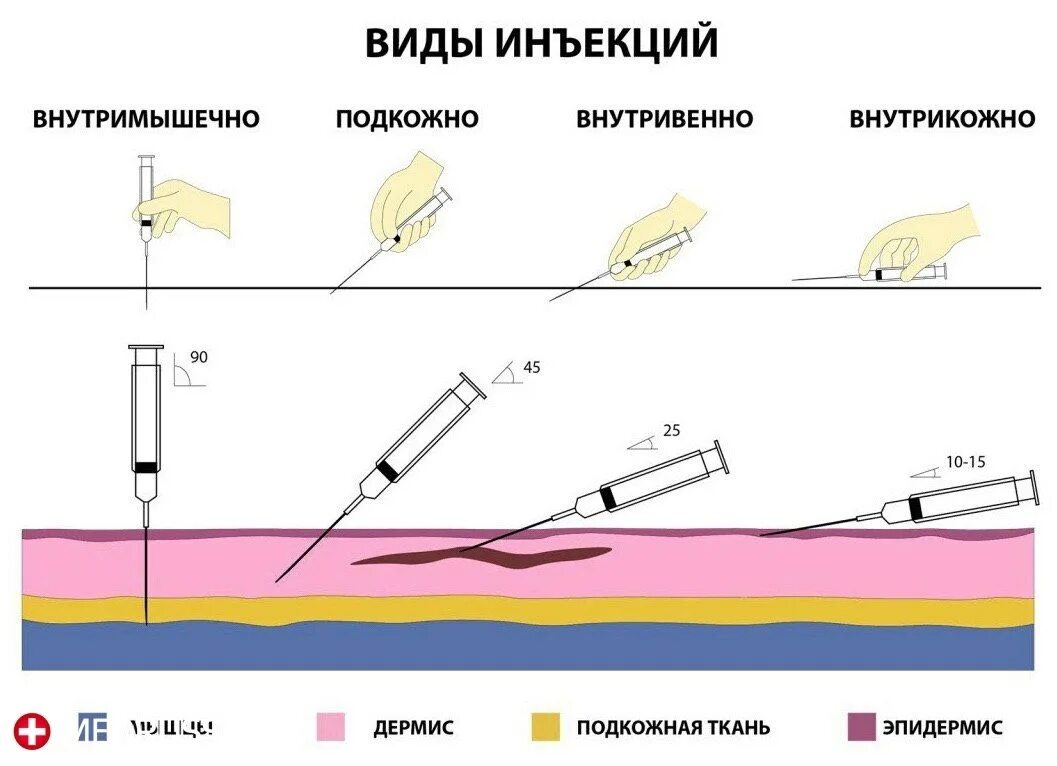 Угол введения внутривенной инъекции. Внутривенная инъекция глубина введения иглы. Углы введения иглы при инъекции. Угол введения иглы при внутривенной инъекции.