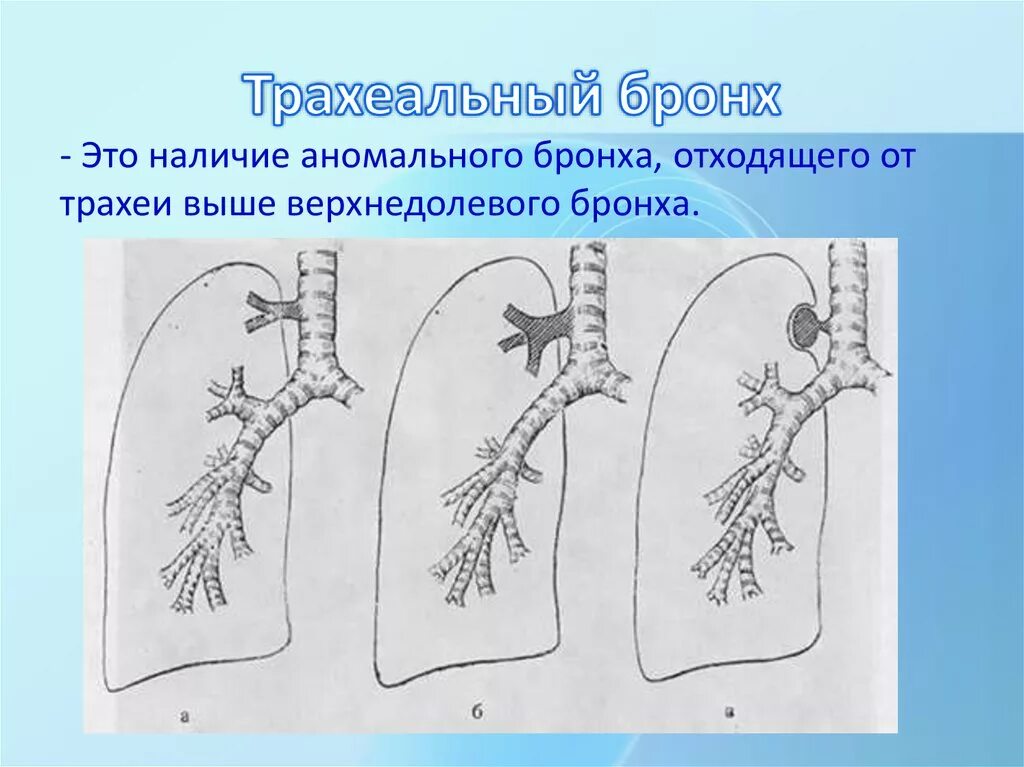 Стадии развития легких. Врожденная аномалия бронхов кт. Аномалии развития бронхиального дерева. Добавочный бронх трахеи. Добавочный трахеальный бронх справа.