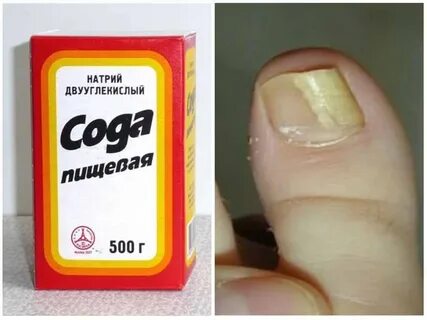 Простые средства от грибка