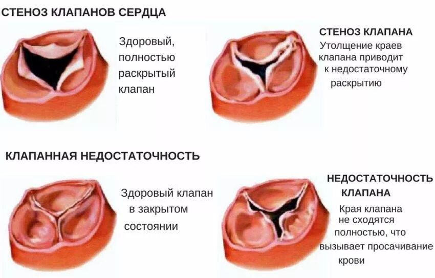 Осложнения стеноза