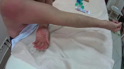 Отек руки после инсульта