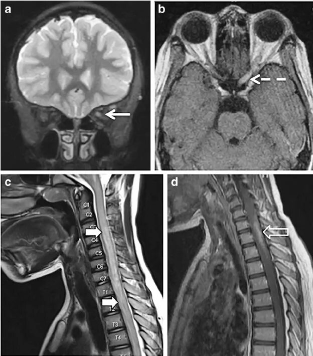 Мрт глазного нерва. Оптиконевромиелит девика. Нейрооптикомиелит девика. Оптикомиелит девика симптомы. Оптикомиелит девика мрт.