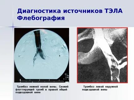 Венозная тромбоэмболия легочной артерии