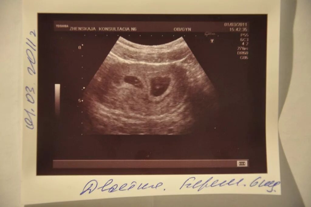 Узи на 5 неделе беременности. Узи 6-7 недель беременности нормы. Плодное яйцо на 7 неделе беременности узи. Узи 3-4 недели беременности. 6 недель 3 дня форум.