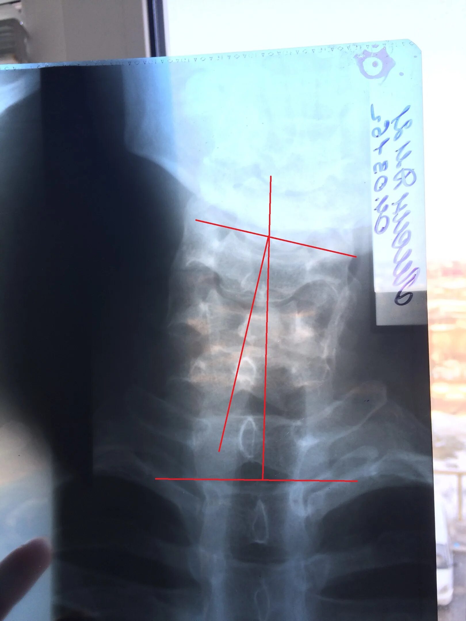 Нестабильность с1. Нестабильность поясничных позвонков на рентгене. Нестабильность с2-с5 шейного отдела позвоночника. Функциональные пробы шейного отдела позвоночника. Нестабильность с2 с4 шейных позвонков.