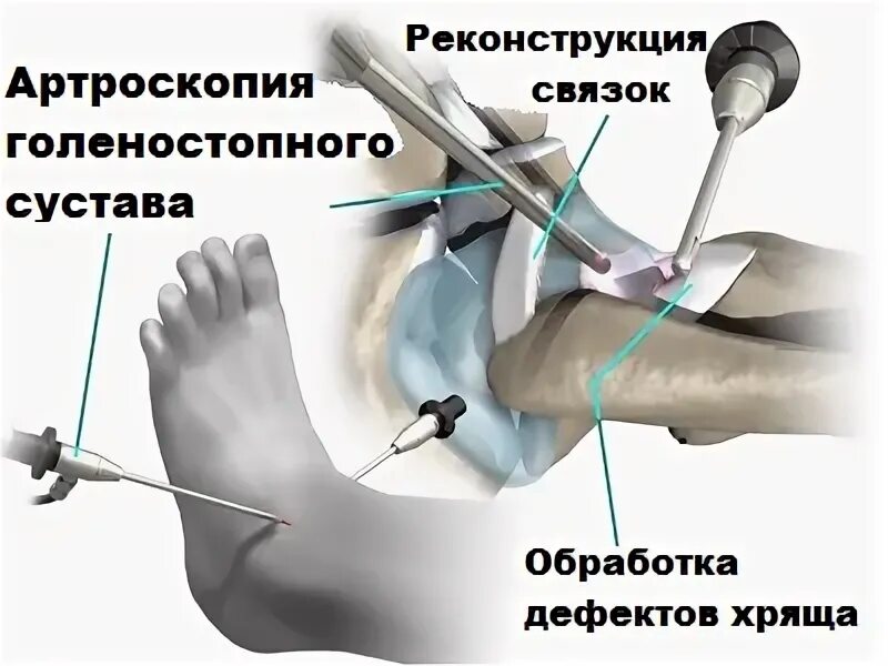 Киров суставы операции. Артроскопическая ревизия голеностопного сустава. Артропластика голеностопного сустава реабилитация после операции. Артроскопия связок коленного сустава. Артроскопический артродез плюснефалангового сустава.