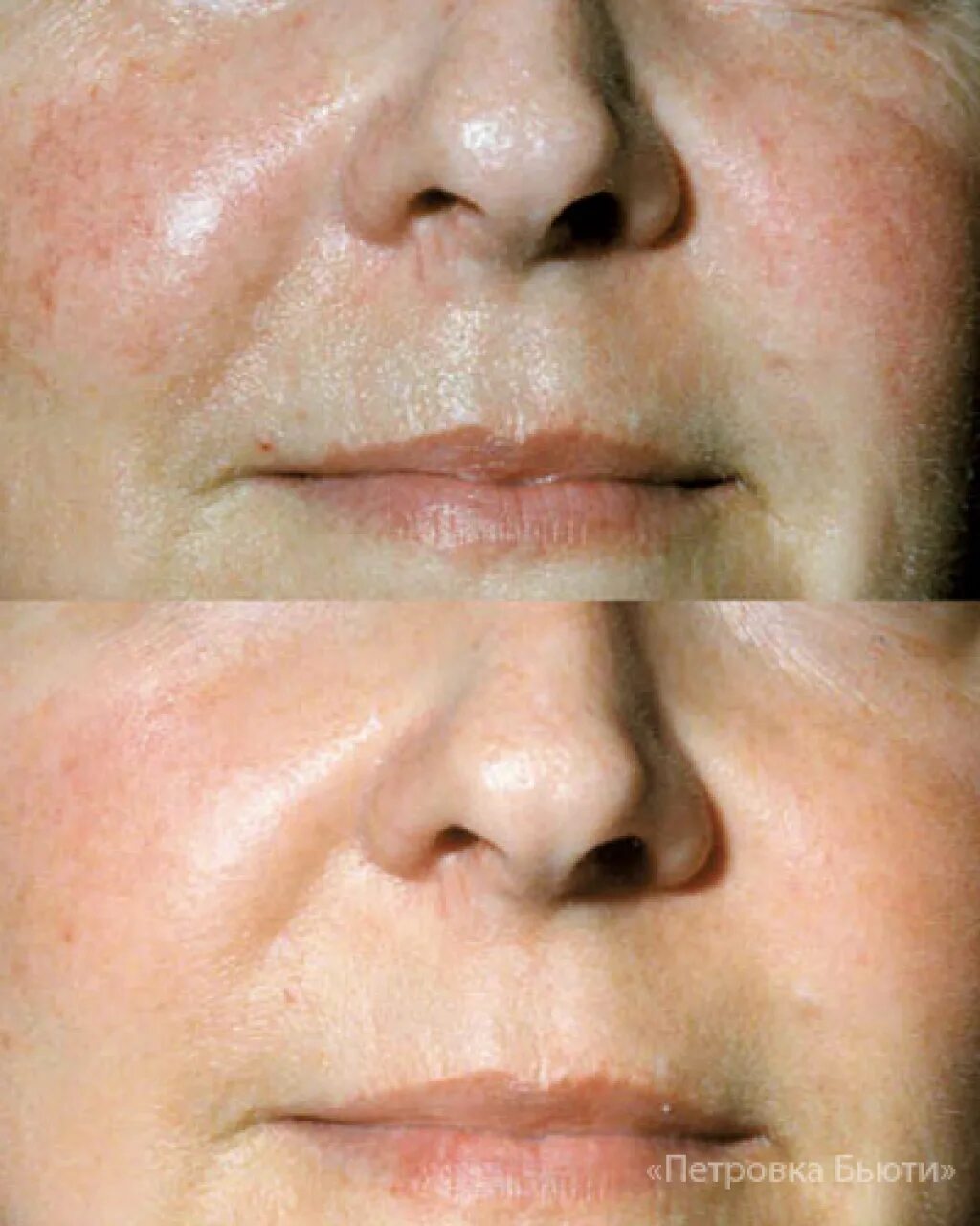 Близко расположенные сосуды. Капиллярные звездочки на лице. Электрокоагуляция купероза. Телеангиоэктазии розацеа. Эритематозно-телеангиэктатическая розацеа.