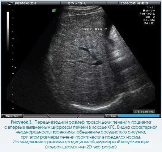 Диффузная жировая инфильтрация печени что это такое. Причины жировой инфильтрации печени. Что значит сосудистый рисунок печени. Воротная вена анатомия кт. Обогащение сосудистого рисунка печени.