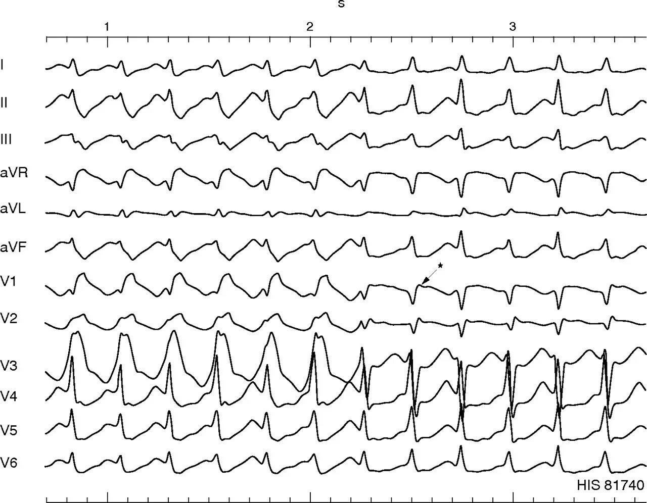 Широкий комплекс qrs. Пароксизмальная тахикардия с широким комплексом qrs на экг. наджелудочковая тахикардия с широкими комплексами. феномен ашмана на экг. фибрилляция предсердий с широким комплексом qrs.