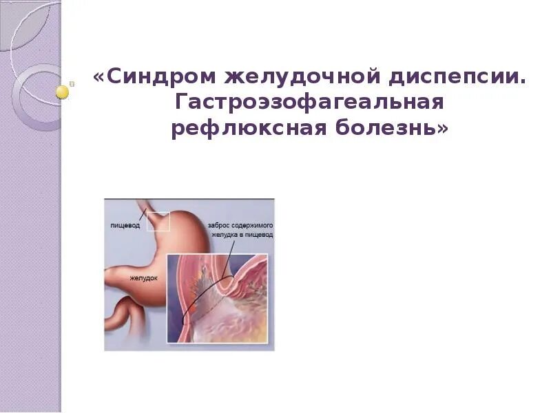 Синдром желудка. Гастроэзофагеальная рефлюксная болезнь презентация. желудочные синдромы. синдром диспепсии презентация. гастроэзофагеальная рефлюксная болезнь ppt.