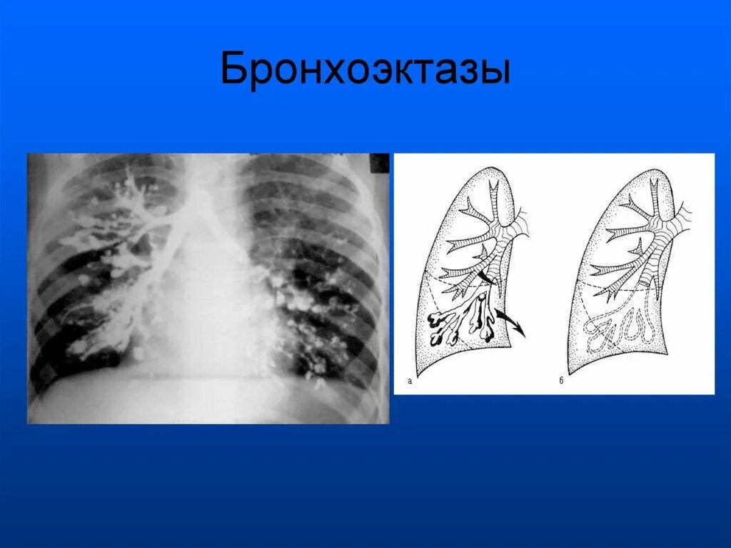 Бронхит бронхоэктатическая болезнь. Бронхоэктазы в легких мешотчатые. Бронхография цилиндрические бронхоэктазы. Мешотчатый бронхоэктаз. Бронхоэктатическая пневмония.