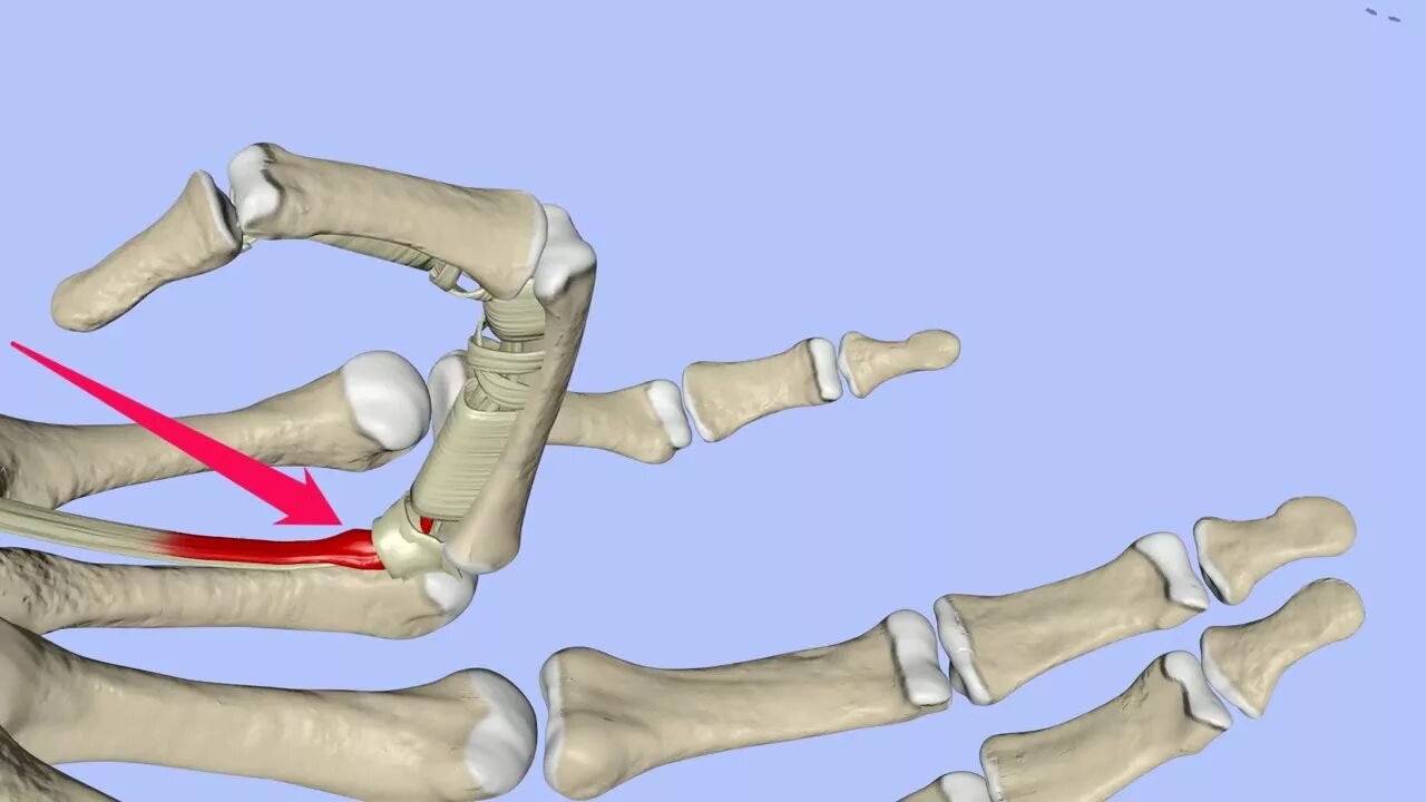 Болезнь Нотта щелкающий палец. Стенозирующий лигаментит щелкающий палец. Стенозирующий лигаментит Нотта. Операция на большом пальце руки