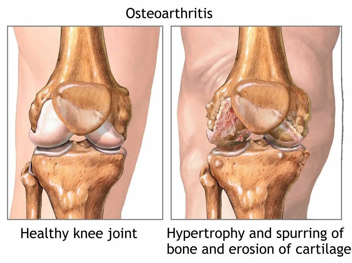 .Деформирующий остеоартрит остеоартроз. Деформационный артроз коленного сустава. Остеоартрит коленного сустава синдромы. Деформирующий остеоартроз поражение суставов. Что разрушает суставы