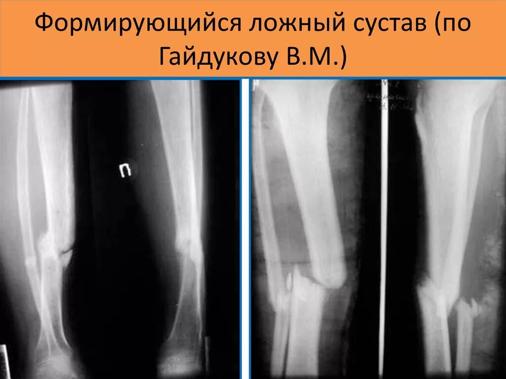 Причина ложного сустава. Причина ложного сустава. Причина ложного сустава. Ложные суставы травматология. Причины образования ложных суставов:.