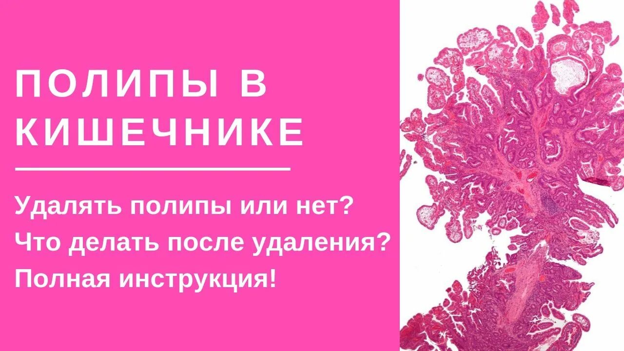 Что кушать после удаления полипа в кишечнике