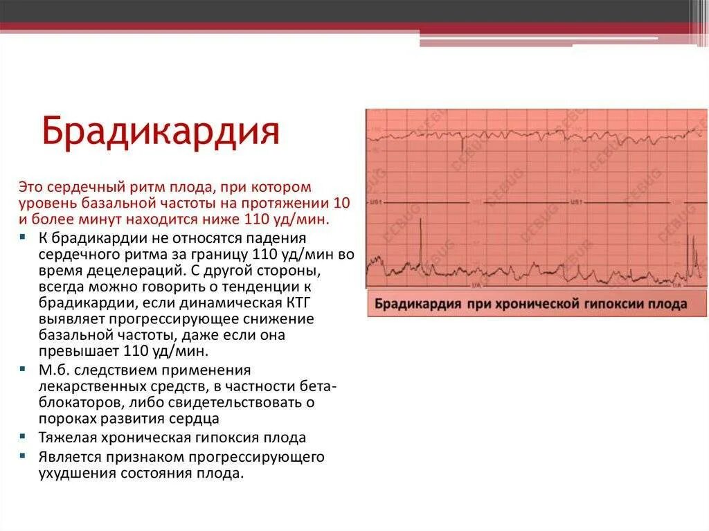 Сердцебиение причины лечение. Брадикардия. Брадикардия плода. Синусовая брадикардия у плода. Брадикардия сердца у плода.