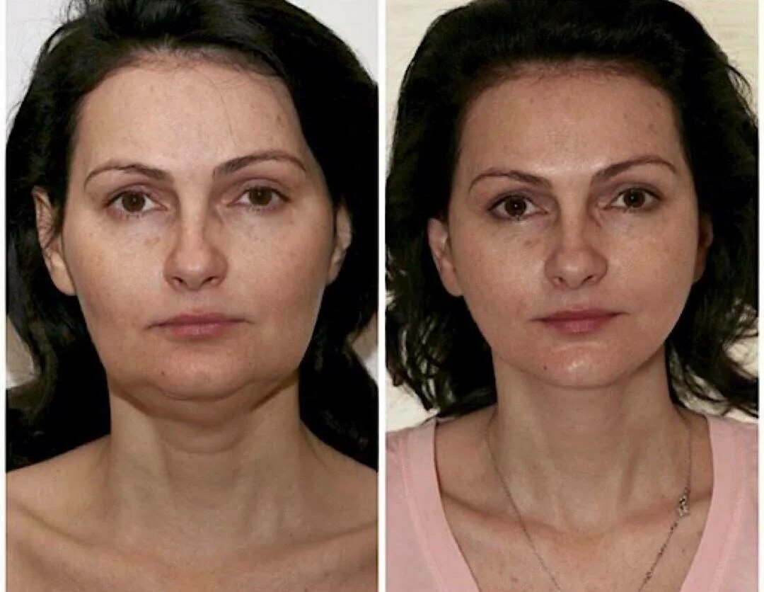 Что нельзя делать после смас лифтинга. Смас лифтинг альтера. смас лифтинг аппаратный подтяжка. подтяжка смас лифтинг.