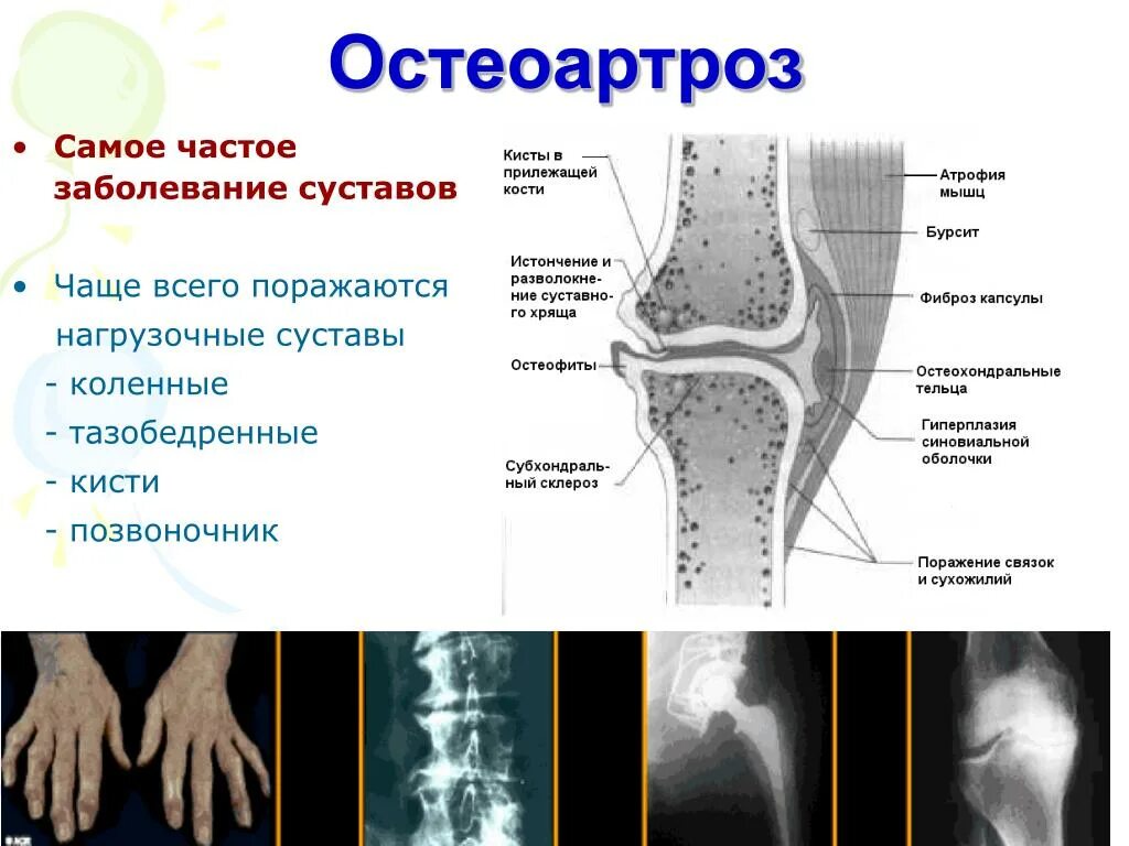 Диагноз доа суставов. .Деформирующий остеоартрит остеоартроз. Остеоартрит остеоартроз остеопороз. Остеоартроз периферических суставов. Деформирующий остеоартроз 2 степени.