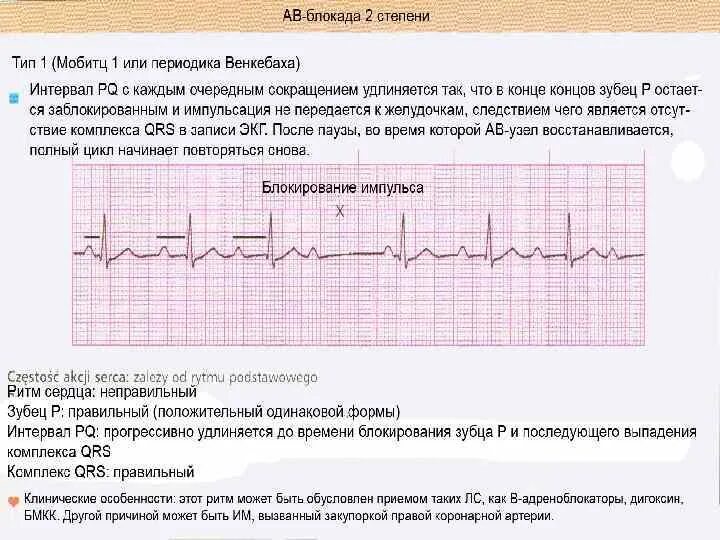 Са блокада 1 степени. Неполная АВ блокада 2 степени Мобитц 1. АВ блокада 2 ст Мобитц 2 ЭКГ. АВ блокада Мобитц 1 и 2 отличия на ЭКГ. АВ блокада 2 степени Мобитц 1 на ЭКГ.