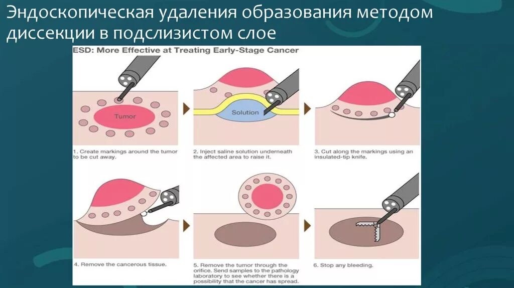 Эндоскопическая резекция слизистой EMR. Эндоскопическая диссекция слизистой оболочки. Эндоскопическая резекция слизистой оболочки пищевода. Эндоскопическая резекция слизистой оболочки желудка. Операция удаления опухоли желудка