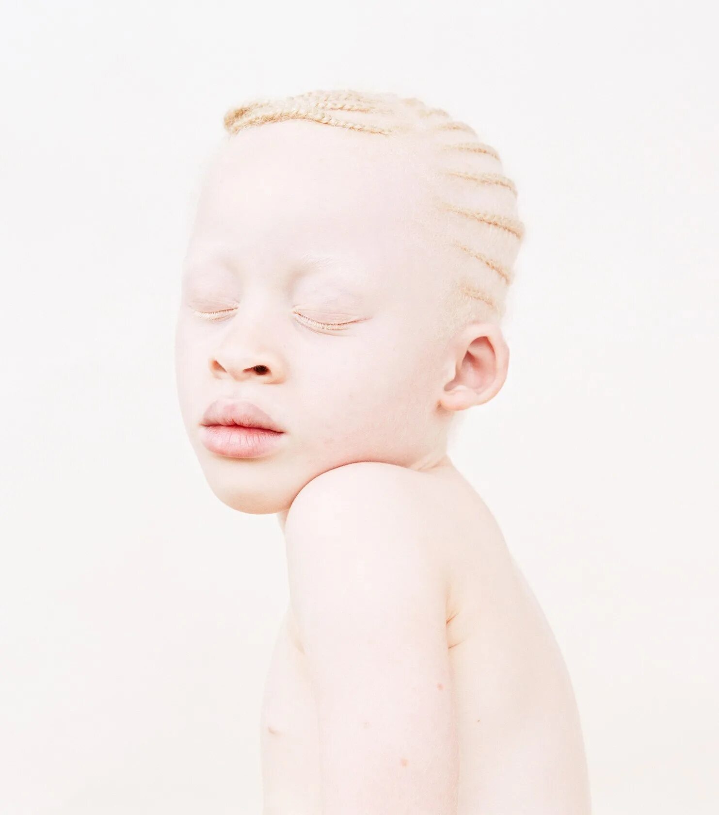 Монголоиды альбиносы. Фенилкетонурия и альбинизм. Глазно-кожный альбинизм. Альбинизм Эстетика. Альбинизмом страдают