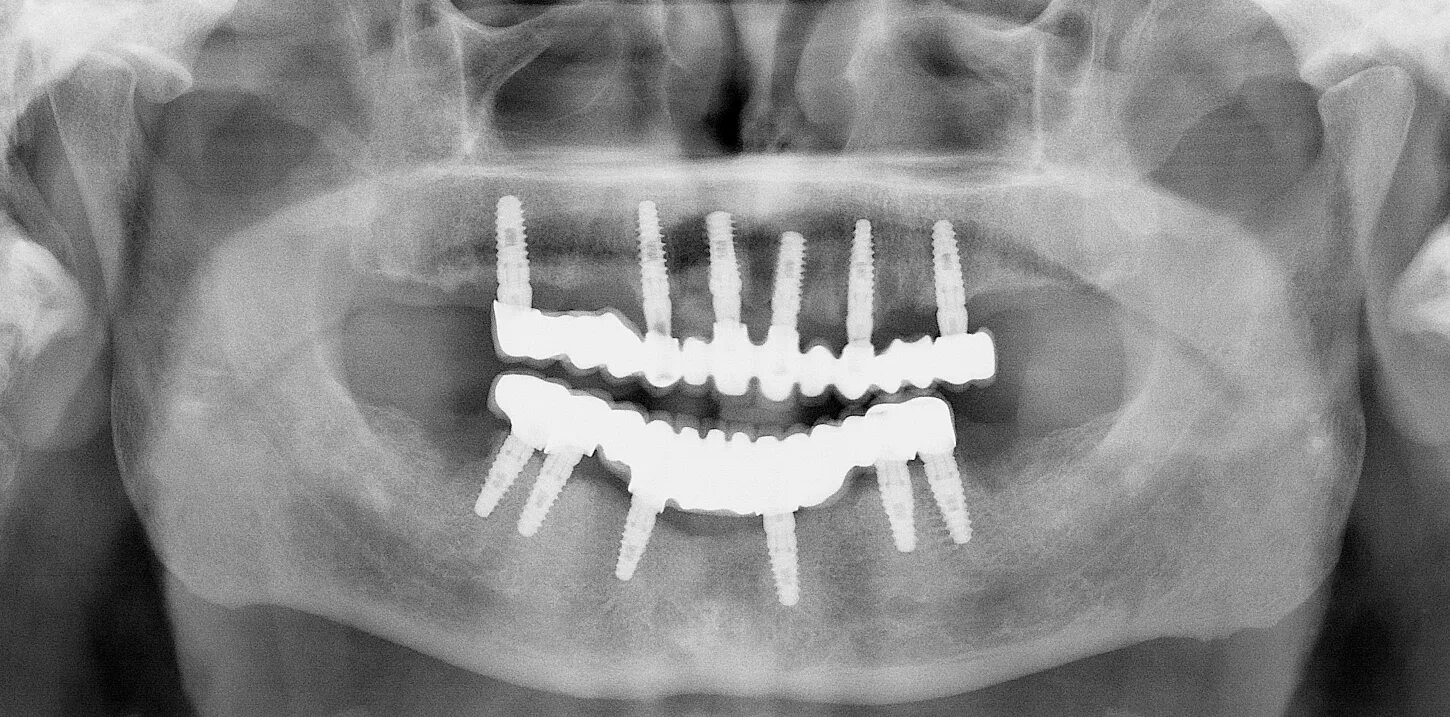 Имплантация зубов all on 6. Имплантация all-on-6 снимок. M4q4 рентген.