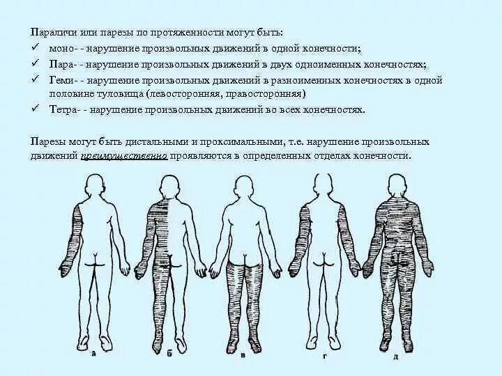 Парезы классификация неврология. Гемипарез это в неврологии. Синдром центрального правостороннего гемипареза. Периферический парез при инсульте. Правый гемипарез