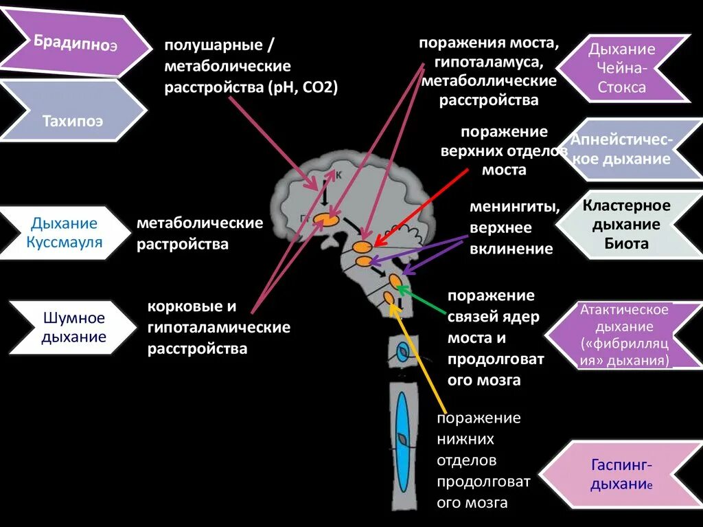 Нарушения моста мозга. Поражение моста мозга симптомы. синдромы поражения моста мозга. поражение моста мозга неврология. симптомы поражения продолговатого мозга.