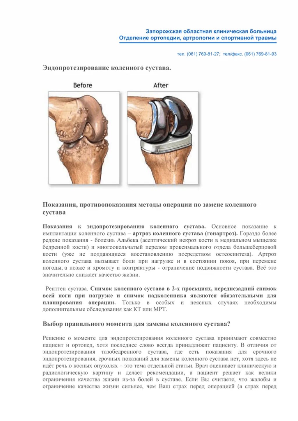 Бесплатная замена коленного сустава. Эндопротезирование коленного сустава. Операция тотального эндопротезирования коленного сустава. ТЭП эндопротезирование коленного сустава. Тотальное эндопротезирование коленного сустава схема операции.