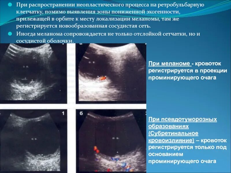 Что такое неопластический процесс. Зона пониженной эхогенности. Неопластического процесса диагностика. Признаки неопластического процесса.