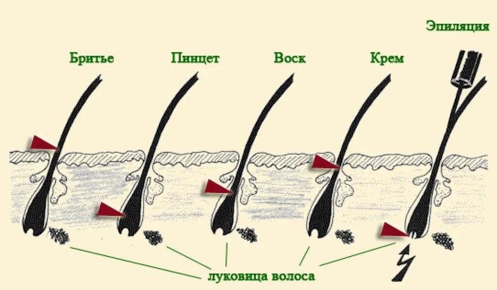 Стимулирование волос. Электроэпиляция зоны бикини схема. Волос с волосяной луковицей. Выдергивание волоса с луковицей.