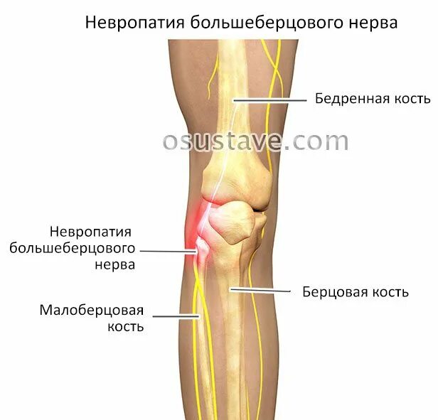 Большеберцовый и малоберцовый нерв. Нервные окончания спереди под коленкой. Невропатия большеберцового нерва. Невропатия большеберцового нерва нерва.