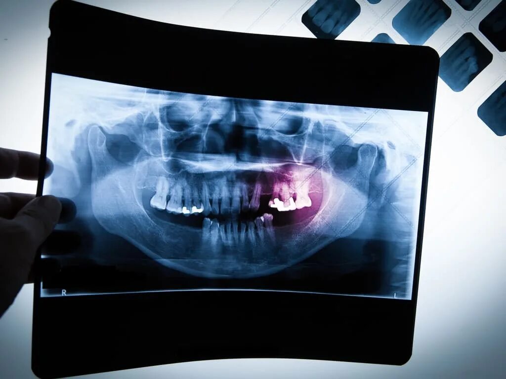Пленка для дентального рентгена. Панорамная рентгенография.