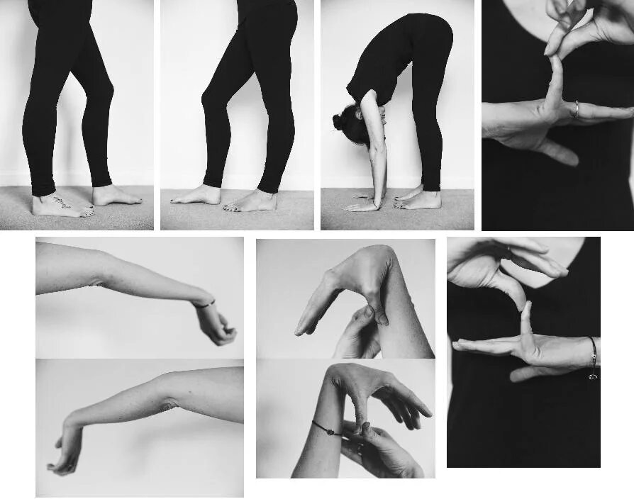 Дисплазия соединительной ткани гипермобильного синдрома. Критерии бейтона признаки гипермобильности суставов. Лфк при гипермобильном синдроме суставов. Марфана гипермобильность суставов. Синдром гипермобильности суставов.