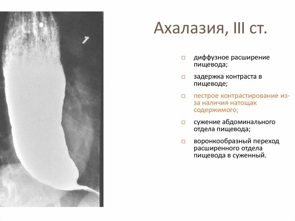 Степени расширения пищевода. Симптомы ахалазии пищевода. Ахалазия пищевода рентгенодиагностика. Сужение ахалазия пищевода. Ахалазия пищевода рентген признаки.