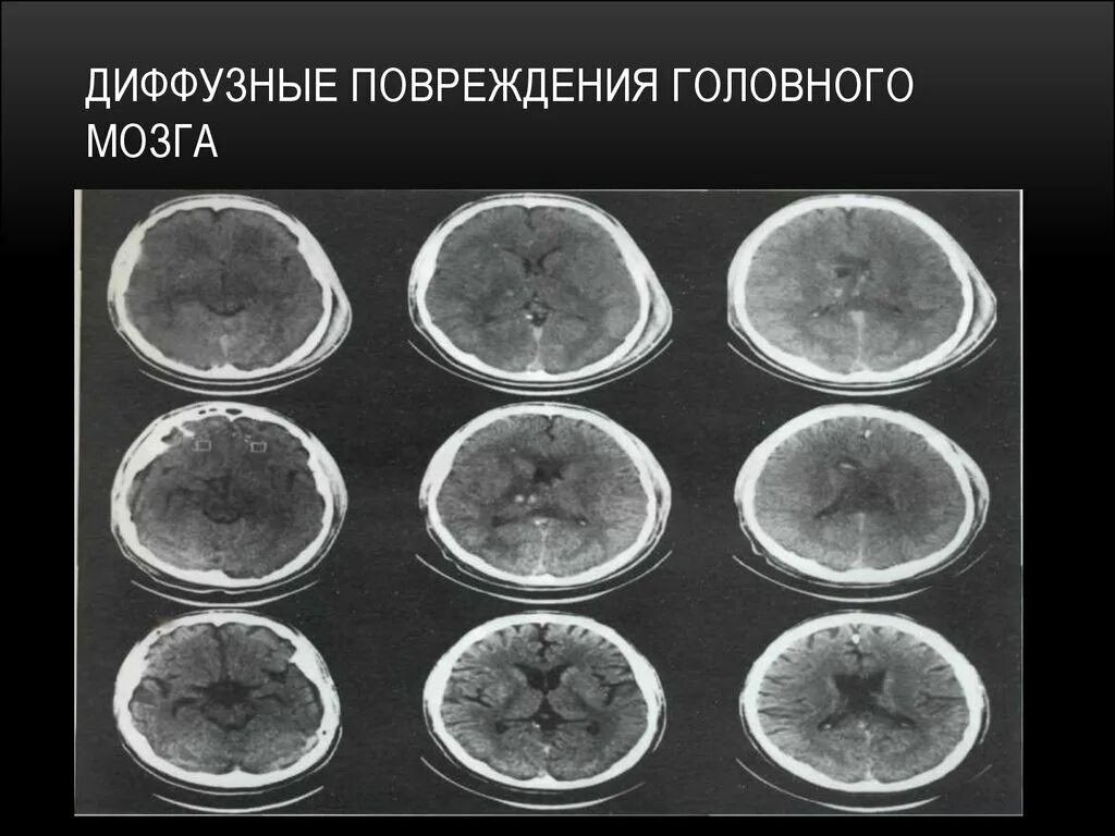 Диффузно аксональные повреждения кт. Диффузное аксональное повреждение головного. Диффузное аксональное повреждение мозга кт. Диффузное аксональное поражение головного мозга на кт. Диффузный характер головного мозга