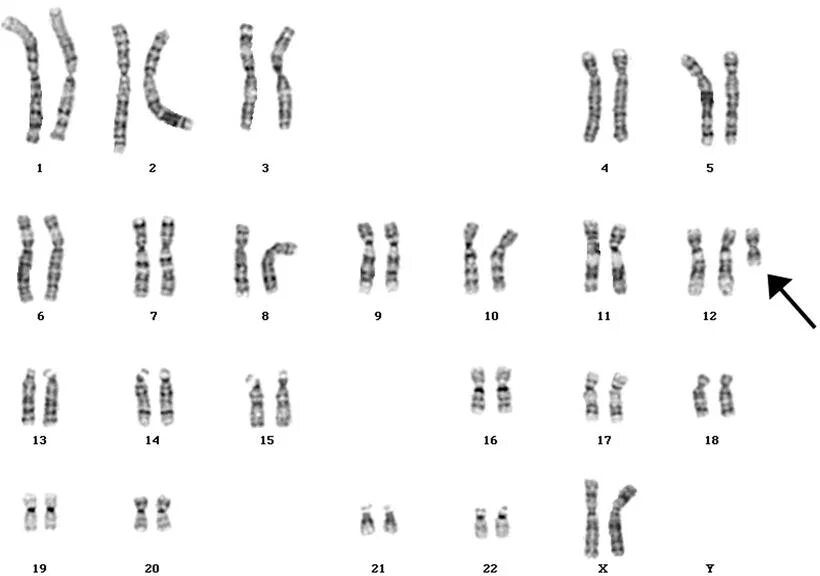 Синдром Ангельмана кариотип. Муковисцидоз кариотип. Кариотип человека с муковисцидозом. Кариотип 3p 12. Поворот хромосом на 180 градусов