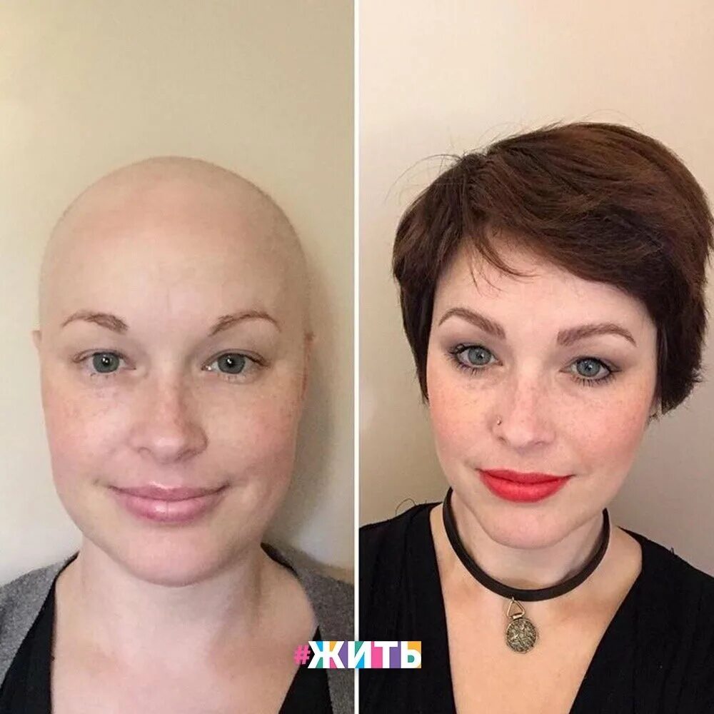 Как жить после рака. Макияж после химиотерапии. Брови после химиотерапии. Перманентный макияж до и после.