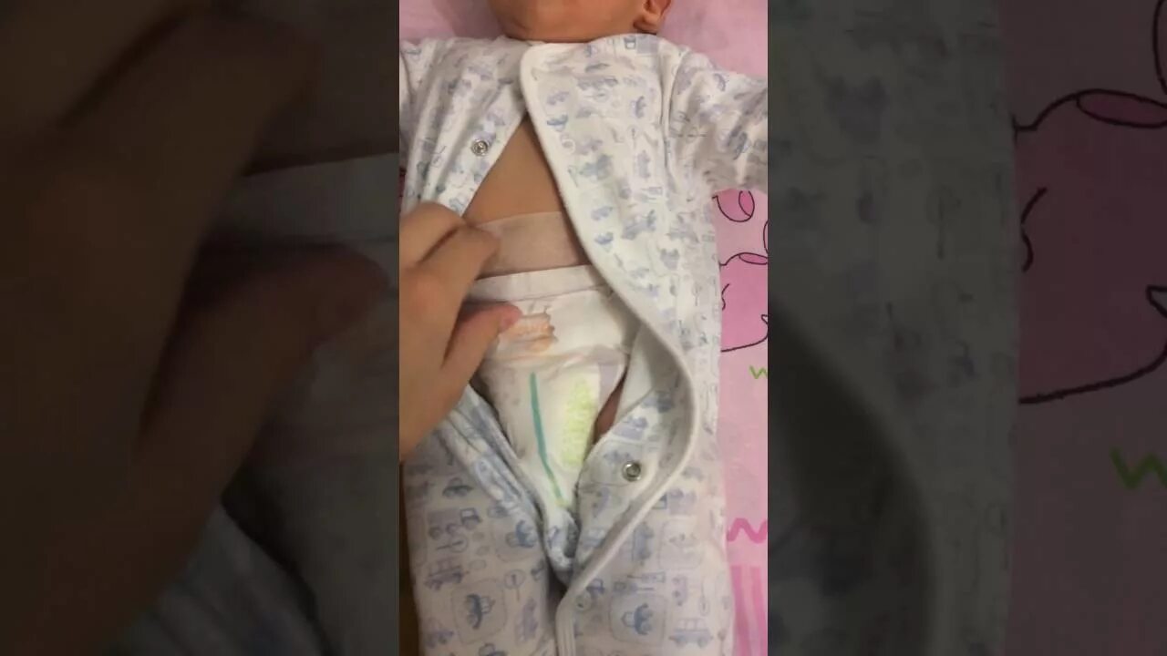 лейкопластырь при пупочной грыже у детей. монетку на пупок. заклеенная пупочная грыжа. пластырь на пупочную грыжу новорожденному. медная монета от пупочной грыжи у детей.