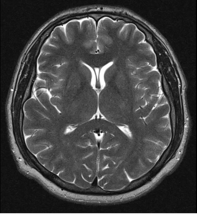 Ликворография головного мозга магнитно-резонансная. Мрт головного мозга норма. Мрт головного мозга Axial норма. MRT головного мозга Norma.